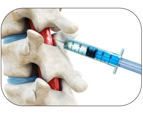 Epidural Injection - Dr. Murali's Pain Centre