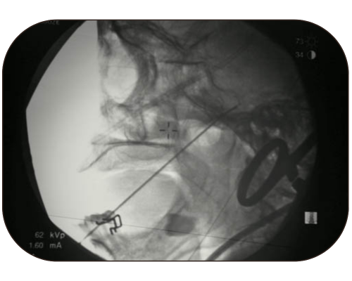 Trigeminal